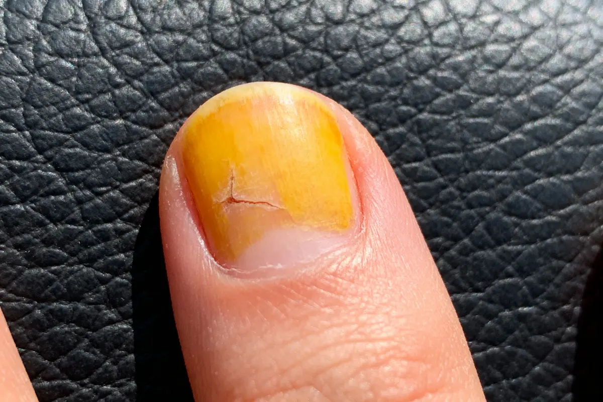 Ongle jauni avec fissure, sur fond texturé noir en gros plan.