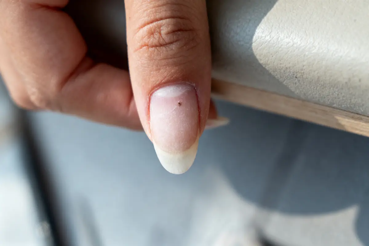 Gros plan d'un ongle de pouce avec une petite marque brune.