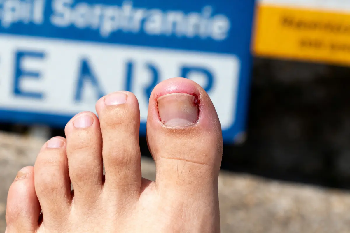 Gros plan d'un pied avec ongle incarné, fond flou.