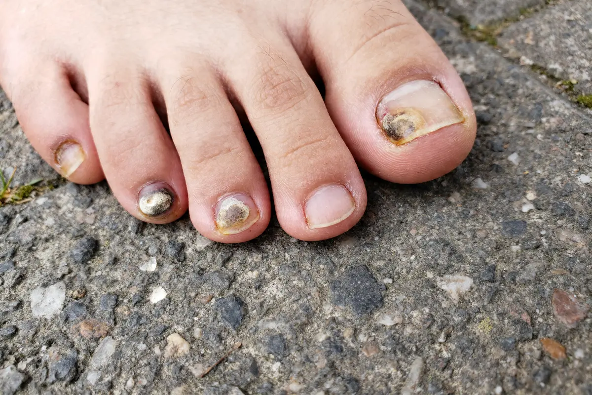Pied avec ongles du pied abîmés et décolorés sur un sol pavé